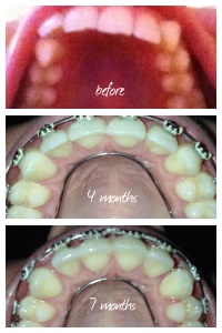 Uppers, 7 months of treatment